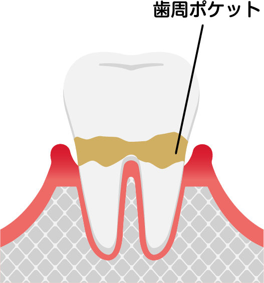 歯周炎（軽度）